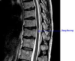 Viêm tủy cắt ngang - Hình ảnh minh họa